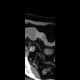 Bowel obstruction, carcinoma of sigmoid colon, SBO, ileus, colorectal cancer: CT - Computed tomography